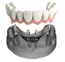 implant secured denture cincinnati oh dentist