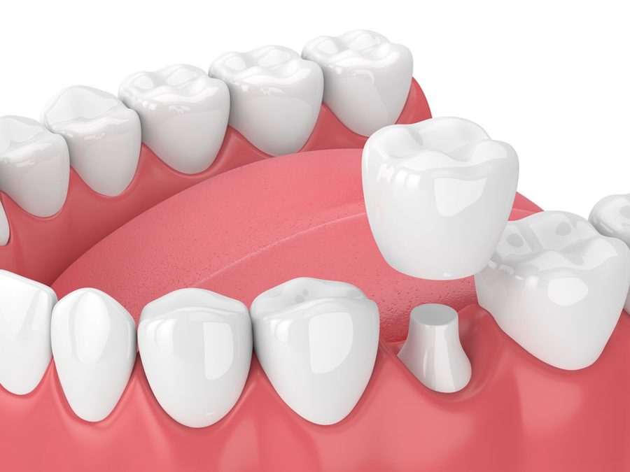 What Can Dental Crowns Fix? Dental Crowns Cincinnati OH