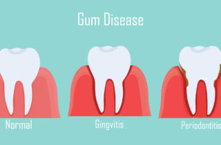 treating gum disease cincinnati oh